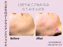 プライベートサロン やすらぎ/アライアンスフェイス症例１回