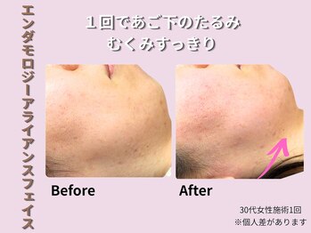 プライベートサロン やすらぎ/アライアンスフェイス症例１回