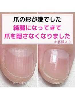 ミミ(mimi)/ささくれが出来なくなりました！