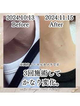 ケア ラウンジ ザ ファースト(THE F1RST)/肌質改善＊施術者本人です※