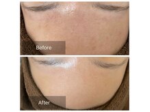 リンダビューティー 室見店(LINDA Beauty)の雰囲気（お顔の艶肌改善、首のシワ改善にもオススメです）