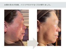 アーブル(Agreable)/赤ら顔/乾燥/血行不良/疲労