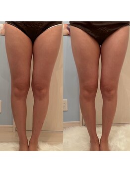 メゾン アンジュ(Maison Ange)/脚1回目/レモンボトル