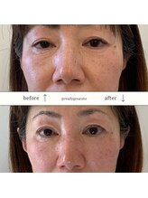 ハリプラス(HariPlus)/美容鍼ビフォーアフター