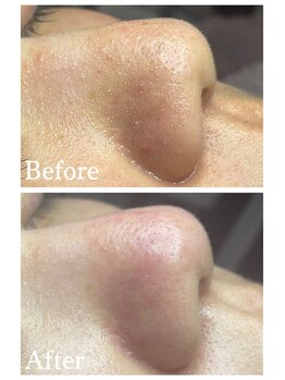 ジェンヌ(jenne.)/毛穴エクストラクション