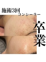サロンツキ(salon tuki)/光フォト症例
