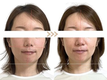 メラリノ(Melalino)/シンメトリー小顔整美♪