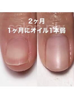 マリーシーオー(MARY-CO.)/深爪矯正