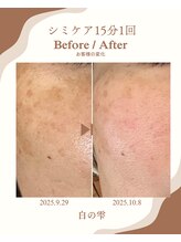 白の雫/頬のシミ｜シミケア1回の変化