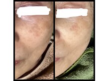 ココスタイルビューティー(COCOSTYLE beauty)の雰囲気（光フェイシャルシミケアし放題）