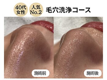 グラツィア(Grazia)/毛穴クリア洗浄コース