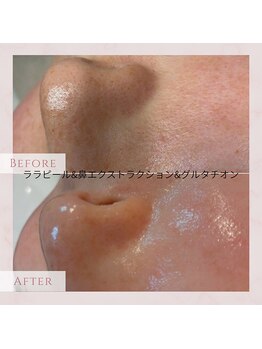 ジーンバイピエル 中野店(gene by PIEL)/#毛穴ケア#ピーリング#ワックス