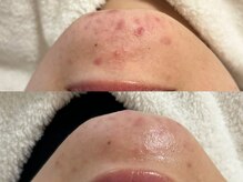 ウララカ(uraraca)/before・after