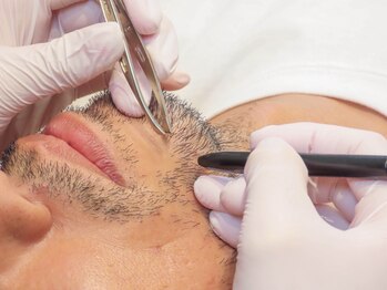 エムディーエスエー(MDSA)の写真/【電気脱毛】ヒゲ~VIO迄全身OK!白髪や光系脱毛の残毛もスッキリ☆開業16年!熟練スタッフが10分50-150本脱毛