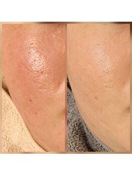 エリン(ERIN)/水光ピール