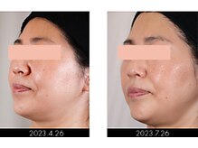 ラグラン銀座メディカルエステ 高輪ゲートウェイ店/【FACE】セルマジ・ビフォアフ