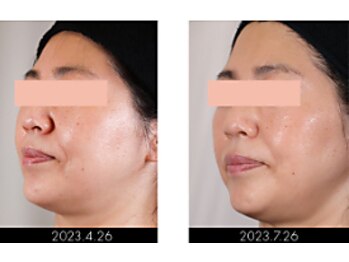 ラグラン銀座メディカルエステ 高輪ゲートウェイ店/【FACE】セルマジ・ビフォアフ