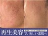 【メンズ限定】肌荒れニキビケアには"再生美容"の美容液導入で美しい素肌に