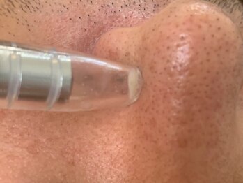 アジーク(AGEQUE)/普段取れない毛穴汚れもごっそり