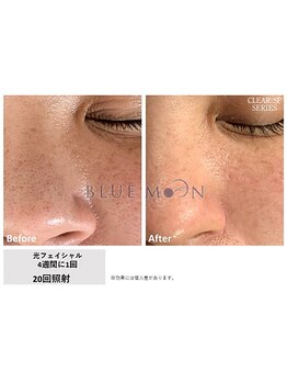 ブルームーン(BLUE MOON)/光フェイシャル×ピーリング