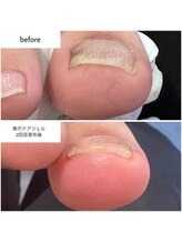 ケアプラス(care plus)/巻爪ケアジェル