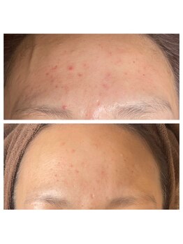 プルメリア(Plumeria)/スヴェイルスキンニキビ効果1