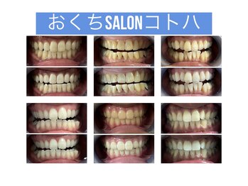 コトハ/セルフホワイトニング症例集2