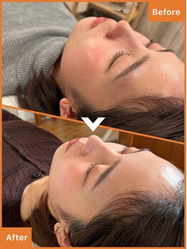 ひだまり鍼灸整骨院/before/after フェイスライン