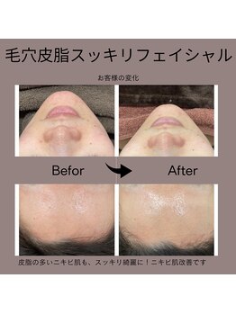 ベルミ―ランド いなげや大和相模大塚/毛穴皮脂スッキリフェイシャル