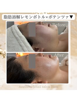 ビヌ(Binu)/脂肪分解レモンボトル・小顔ケア