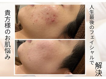 リヴェーヌ 呉羽店(Riverne)の写真/【人生最後の肌質改善へ】肌荒れ、乾燥、毛穴、くすみ!!贅沢に生コラーゲンを使用。肌結果へ導きます♪