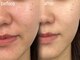 メルシートータルビューティー(MERCI)の写真/美白ケアで夏のお疲れ様肌をケア！肌白い印象へ導く、つるんとした透ける白肌♪