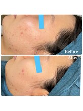 ちらちゅら/クリスティーナ【施術経過】