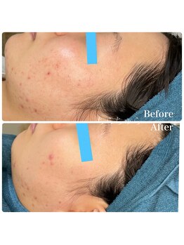 ちらちゅら/クリスティーナ【施術経過】