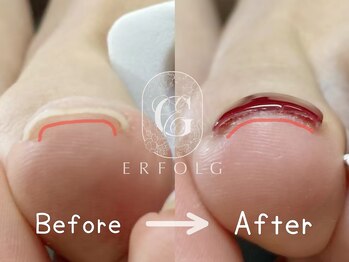 エアフォルク 銀座(ERFOLG)/巻き爪矯正！目立たず、即効性◎