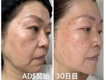 エルブラン(Herb ame)/肌改善30日目