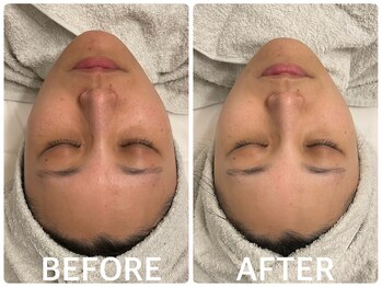 ハーブピーリング 恵比寿/くすみ/毛穴/透明感