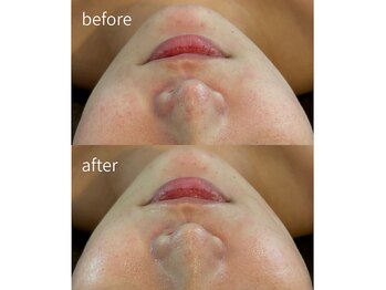 ヒミー(himee)/ハーブピーリング/毛穴/肌質改善