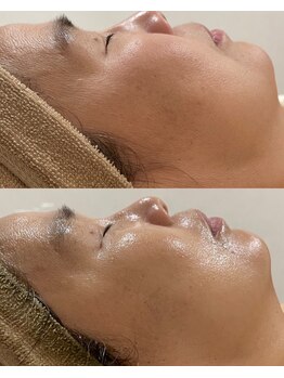 aura.まつげ・ハーブピーリング専門店/ハーブピーリング1回での変化