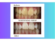 ホワイトニングショップ北四番丁店【4月中旬 NEW OPEN（予定）】/【ビフォーアフター】