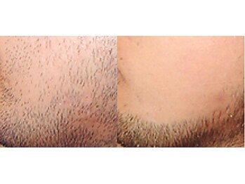 パウザ(PAUSA)/美療脱毛（男性ひげ）