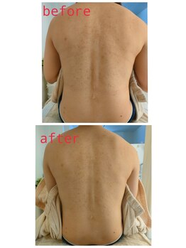 サロンドットブレスドットケイ(salon.bless.k)/人気メニュー背中タラソパック