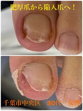 巻き爪じゅん 千葉駅前店/巻き爪ですか？爪が痛い！