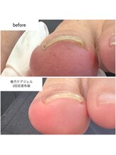 ケアプラス(care plus)/巻爪ケアジェル