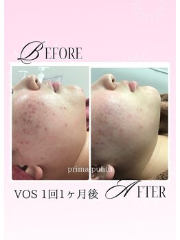 プリマプリート 各務原店/VOSでニキビケア！