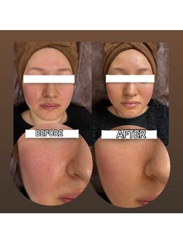 ラヴィ コロレ(La vie colore)/光フェイシャル