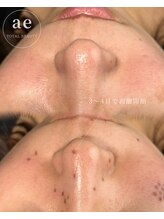 アエ(ae)/シミケア直後のお写真