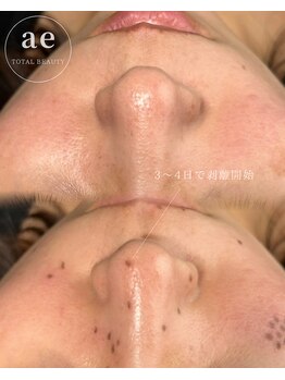 アエ(ae)/シミケア直後のお写真