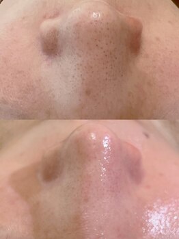 フェリノ(FERINO)/【オプション】ハイドラ毛穴洗浄