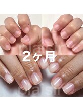 マリーシーオー(MARY-CO.)/深爪矯正